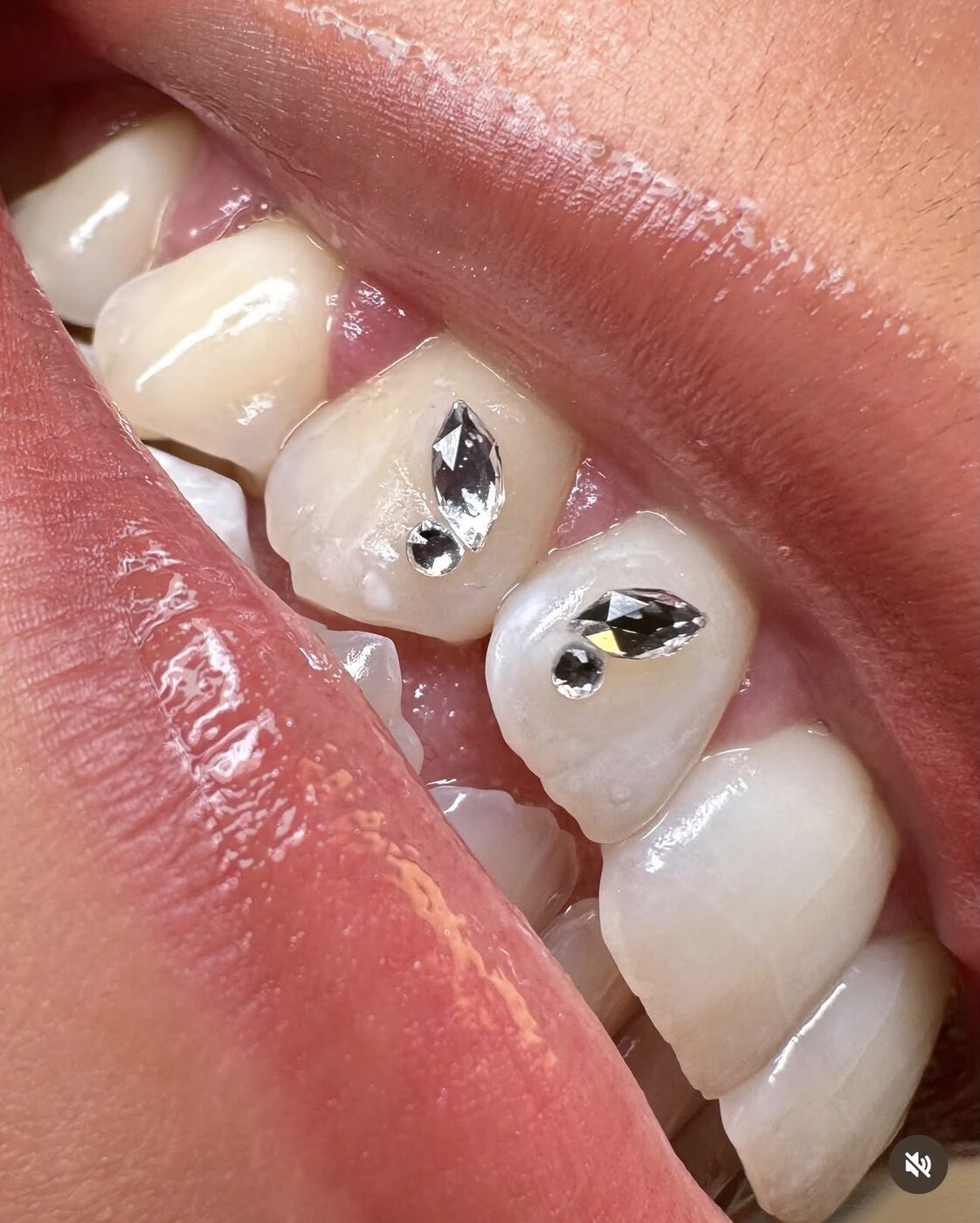 Tooth Gems